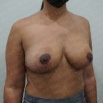 Breast Lift Before & After Patient #2805