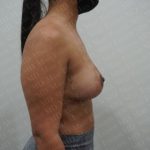 Breast Lift Before & After Patient #2805
