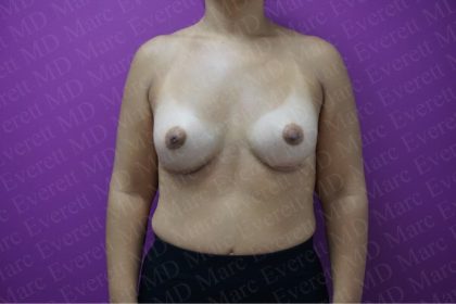 Breast Augmentation Before & After Patient #2604