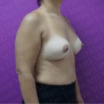 Breast Augmentation Before & After Patient #2604