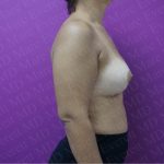 Breast Augmentation Before & After Patient #2604