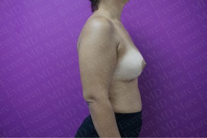 Breast Augmentation Before & After Patient #2604