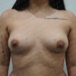 Fat Grafting Breast Augmentation Before & After Patient #2731