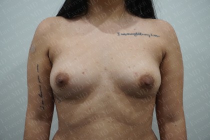 Fat Grafting Breast Augmentation Before & After Patient #2731