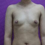 Breast Augmentation Before & After Patient #2965