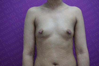 Breast Augmentation Before & After Patient #2965