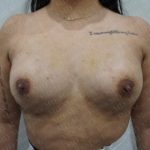 Fat Grafting Breast Augmentation Before & After Patient #2731
