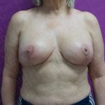 Breast Lift Before & After Patient #2877