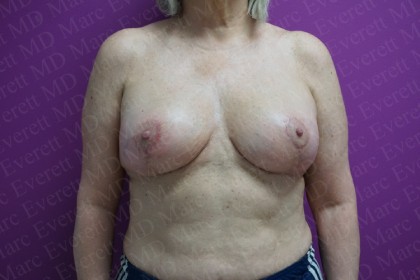 Breast Lift Before & After Patient #2877