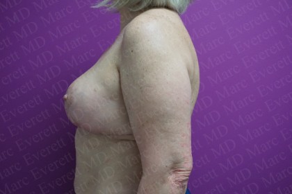 Breast Lift Before & After Patient #2877