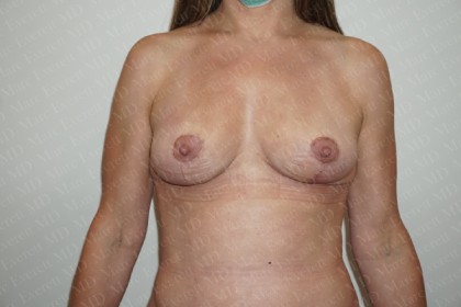 Fat Grafting Breast Augmentation Before & After Patient #2717