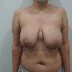 Breast Lift Before & After Patient #2830