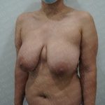 Breast Lift Before & After Patient #2830