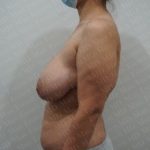 Breast Lift Before & After Patient #2830