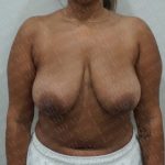 Breast Lift Before & After Patient #2804