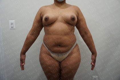 Liposuction Before & After Patient #2762