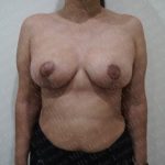 Breast Lift Before & After Patient #2830