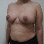 Breast Lift Before & After Patient #2830