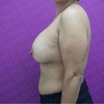 Breast Augmentation Before & After Patient #2652