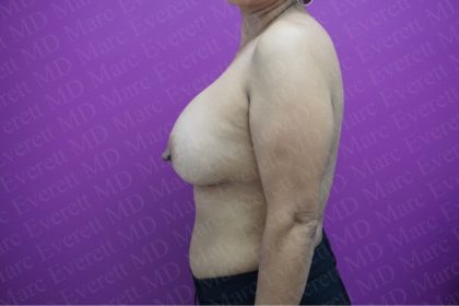 Breast Augmentation Before & After Patient #2652