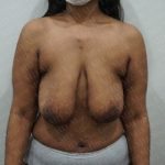 Fat Grafting Breast Augmentation Before & After Patient #2683