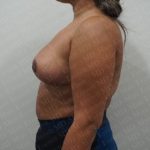 Breast Lift Before & After Patient #2804