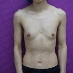 Breast Augmentation Before & After Patient #2612