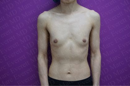 Breast Augmentation Before & After Patient #2612