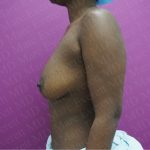 Breast Augmentation Before & After Patient #2668