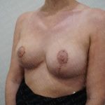 Breast Lift Before & After Patient #2777