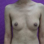 Breast Augmentation Before & After Patient #2623
