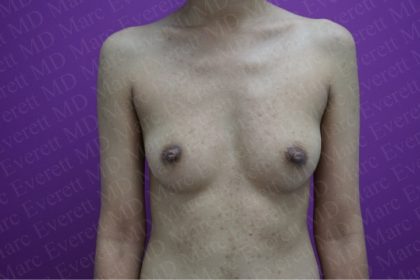 Breast Augmentation Before & After Patient #2623