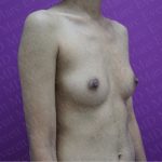 Breast Augmentation Before & After Patient #2623