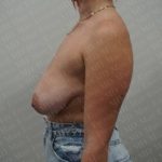 Fat Grafting Breast Augmentation Before & After Patient #2724