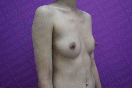 Breast Augmentation Before & After Patient #2623