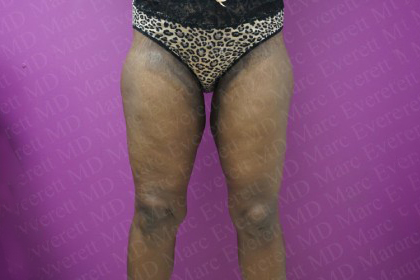 Thigh Lift Before & After Patient #2738