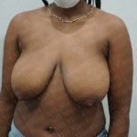 Breast Lift Before & After Patient #2767