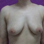 Breast Augmentation Before & After Patient #2963