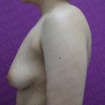Breast Augmentation Before & After Patient #2963