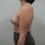 Fat Grafting Breast Augmentation Before & After Patient #2724
