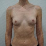 Breast Augmentation Before & After Patient #2966