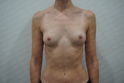 Breast Augmentation Before & After Patient #2966