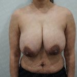 Breast Reduction Before & After Patient #2880