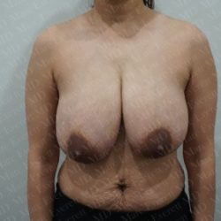 Breast Reduction Before & After Patient #2880
