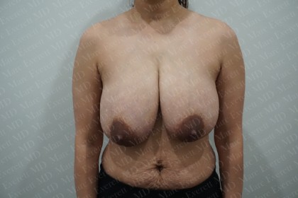 Breast Reduction Before & After Patient #2880