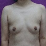 Breast Augmentation Before & After Patient #2967