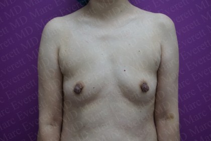 Breast Augmentation Before & After Patient #2967