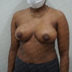 Breast Lift Before & After Patient #2767