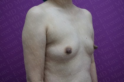 Breast Augmentation Before & After Patient #2967