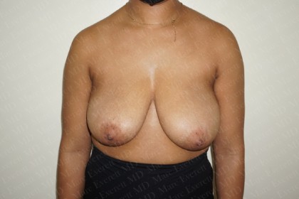 Breast Lift Before & After Patient #2803